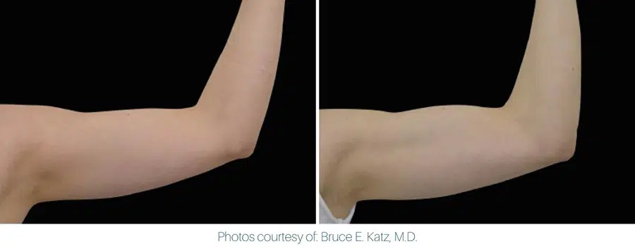 An image showing an Emsculpt Neo before and after of a woman's arm.
