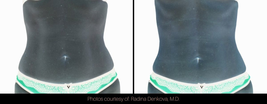 An image showing an Emsculpt Neo before and after of a woman's belly.