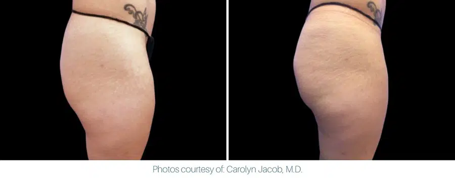 An image showing an Emsculpt Neo before and after of a woman's thigh.