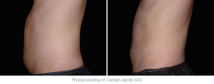 An image showing an Emsculpt Neo before and after of a man's belly.