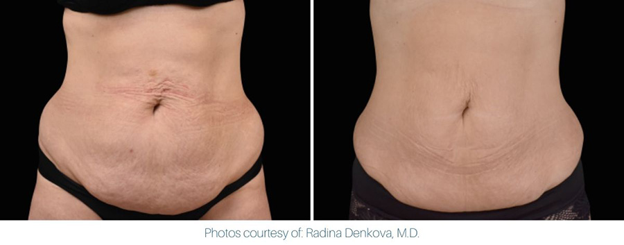 An image showing an Emsculpt Neo before and after of a woman's belly.