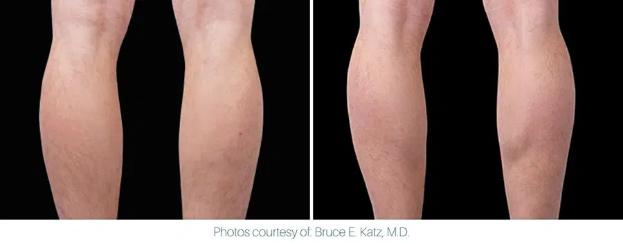 An image showing an Emsculpt Neo before and after in the legs.