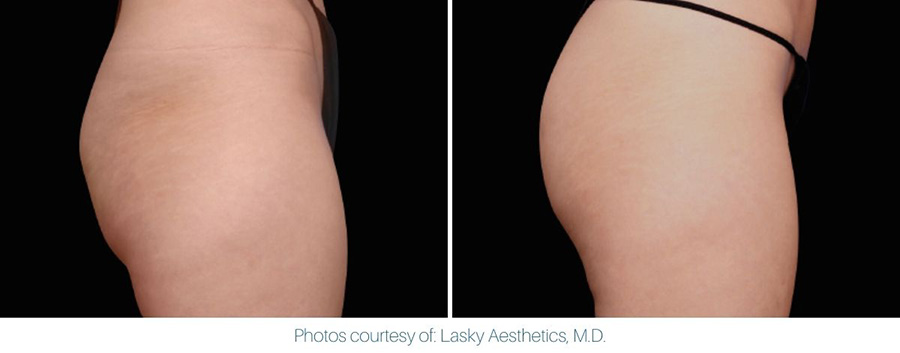 An image showing an Emsculpt Neo before and after of a woman's thigh.