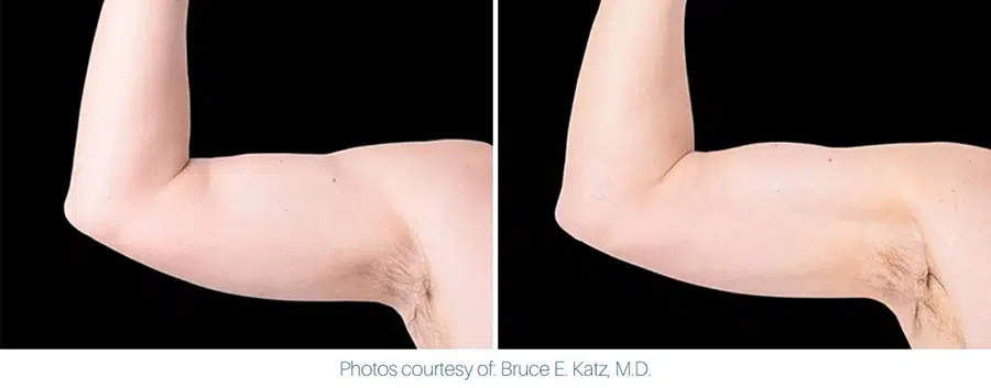 An image showing an Emsculpt Neo before and after of a man's arm.